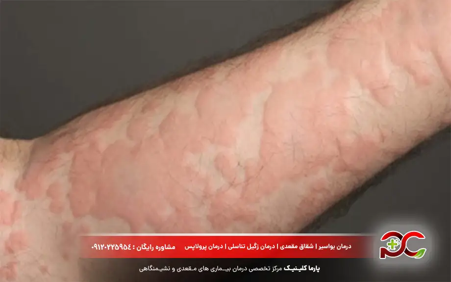 عوارض قرص آموکسی‌ سیلین