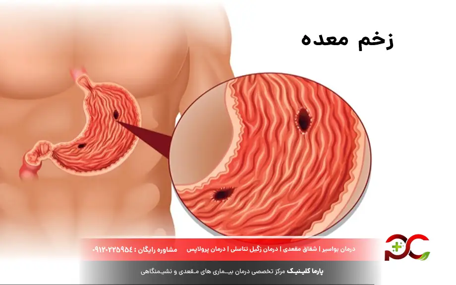 زخم معده؛ دشمن خاموش دستگاه گوارش را بشناسید