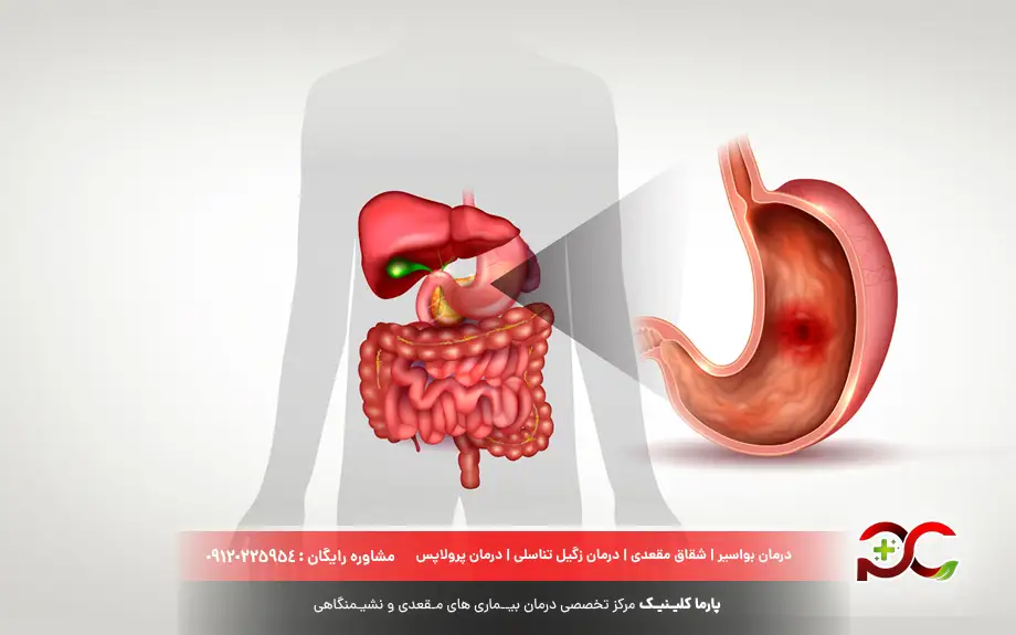 علائم زخم معده و سرطان معده