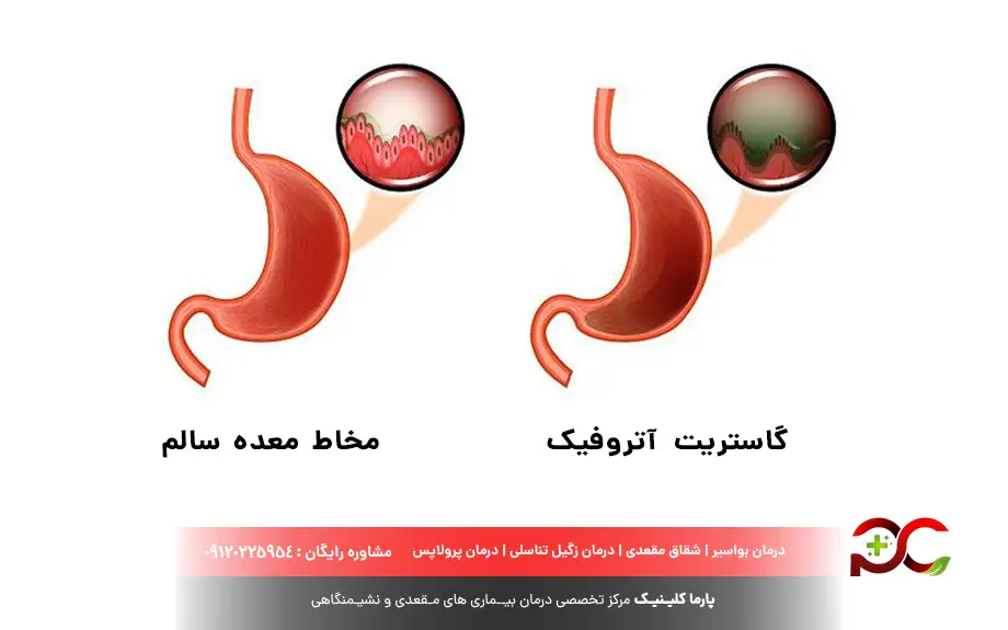 گاستریت آتروفیک