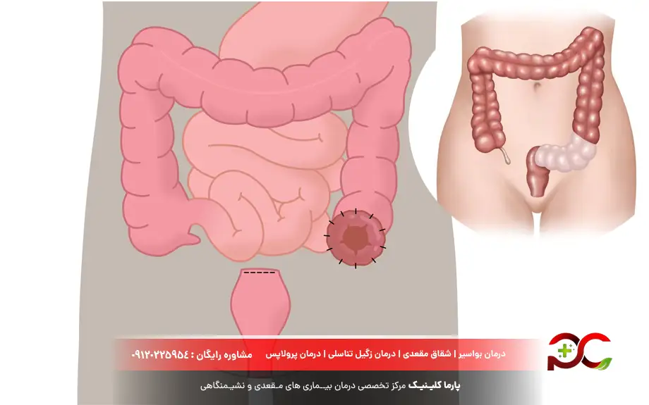 جراحی سیگموئید