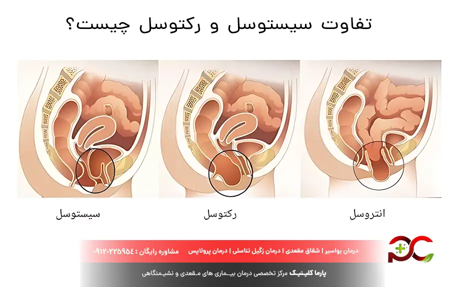 تفاوت سیستوسل و رکتوسل چیست؟
