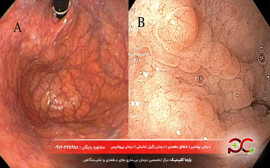 عکس ورم معده در آندوسکوپی