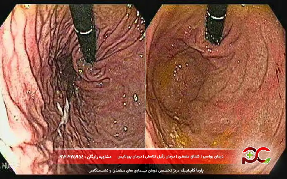 عکس آندوسکوپی معده سالم 