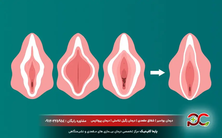 تغییر سایز واژن