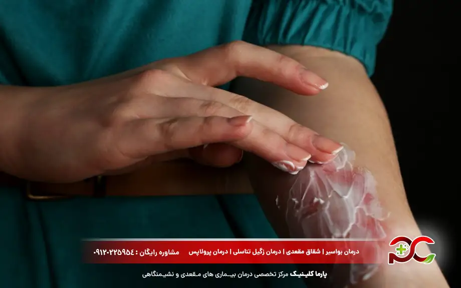 پماد موپیروسین برای سوختگی