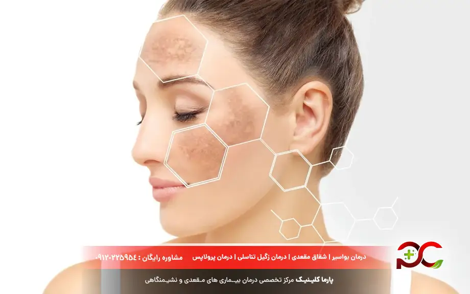 پماد موپیروسین برای لک صورت