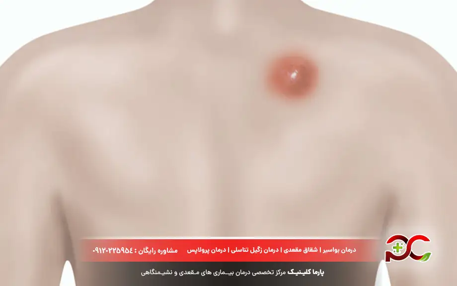 پماد موپیروسین ۲ درصد برای جوش