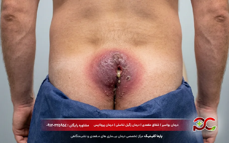 عکس کیست دنبالچه