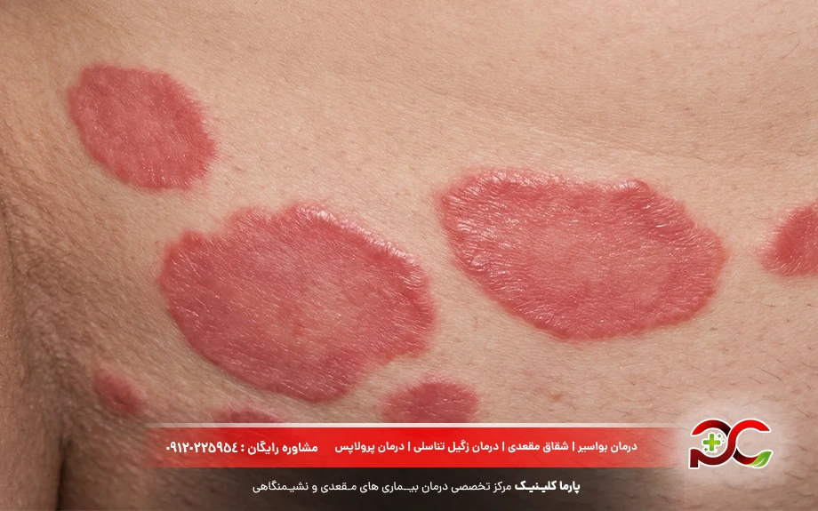 تصویر پسوریازیس تناسلی
